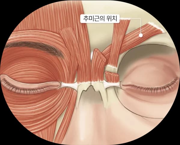 适当的皱眉肌切除