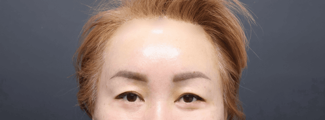 이마거상 수술 후