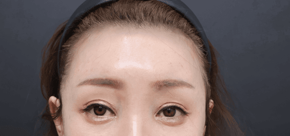 이마거상 수술 후