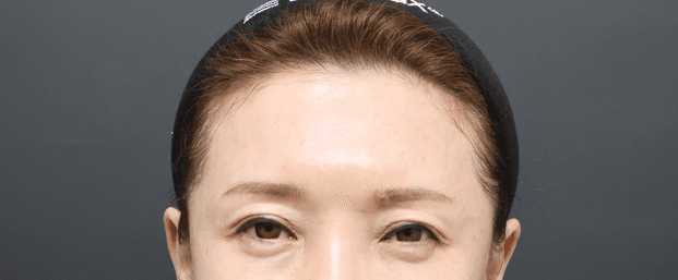 이마거상 수술 전